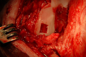 Cartilage defect created on the femur