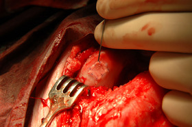 Injection of cartilage cells under the periosteal flap