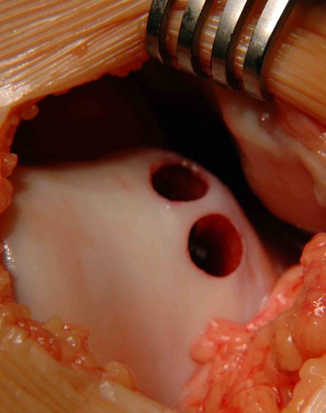 térdízület implantáció térdízület ízületi gyulladásos kezelése